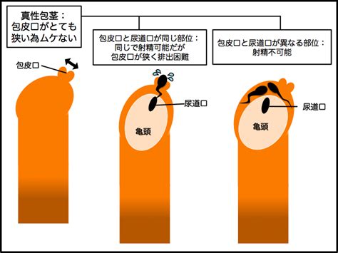 【泌尿器科の医師が解説】包茎は手術ナシで矯正でき。